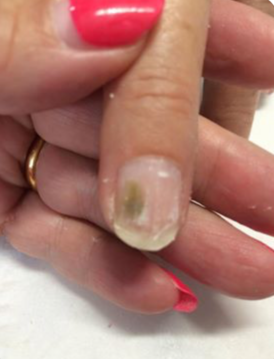 mold under acrylic nails        
        <figure class=